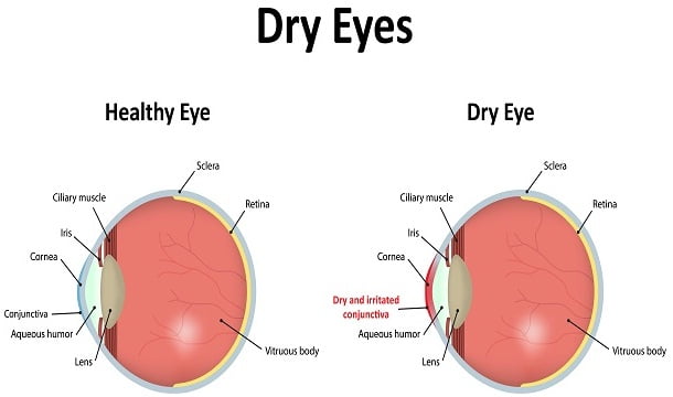 Dry Eye Syndrome And Its Prevalence Diseasefix