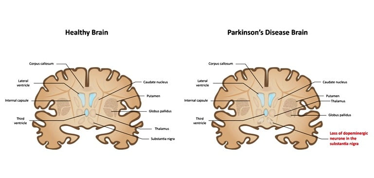 parkinson’s_disease_or_syndrome