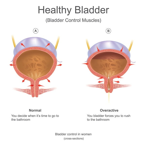 Risk Factors And Causes Of Urinary Incontinence Diseasefix 4246