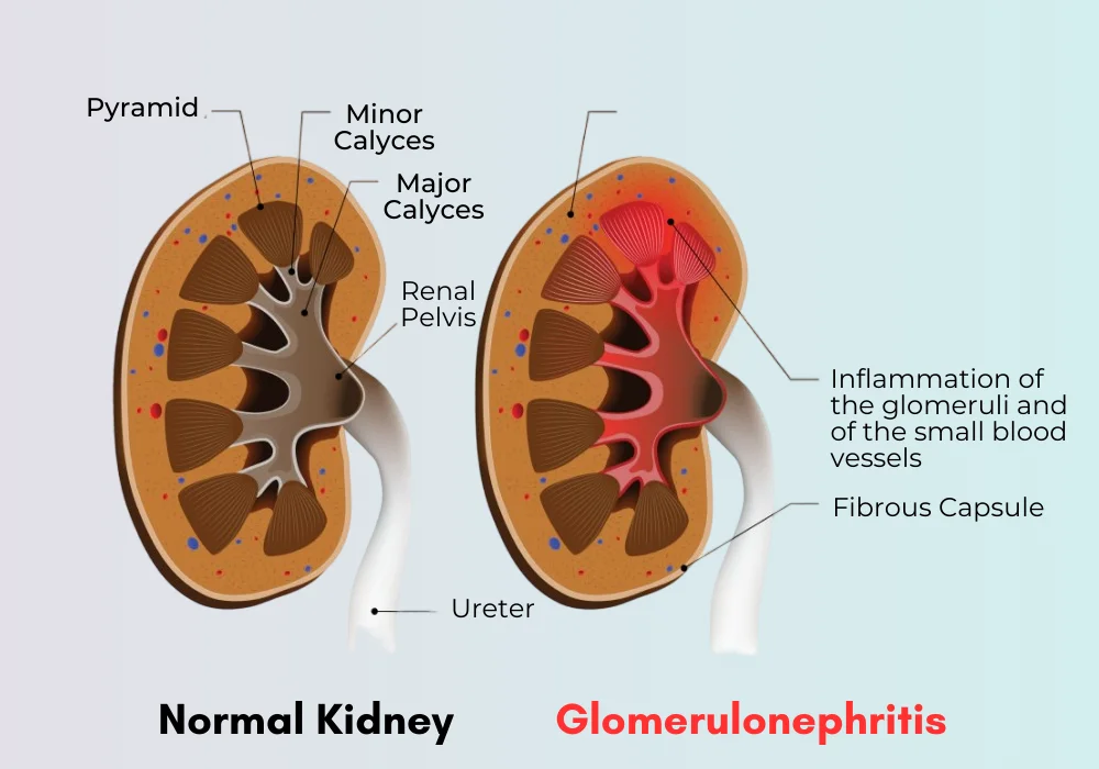 Glomerulonephritis