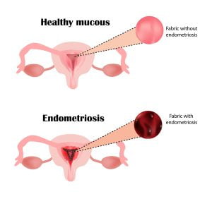 structure of the pelvic organs in a healthy woman vs in a woman with endometriosis.