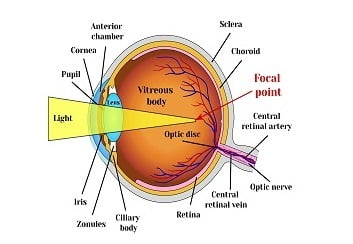 What Is Myopia (Nearsightedness)?