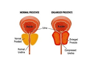 What Are the Signs and Symptoms of Enlarged Prostate