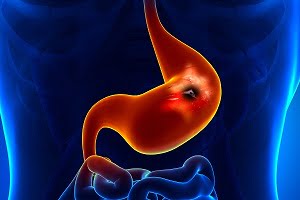Overview of Stomach Cancer
