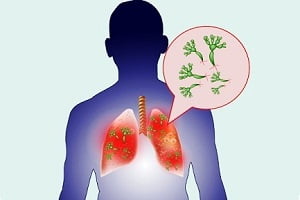 What is a Lung Cancer