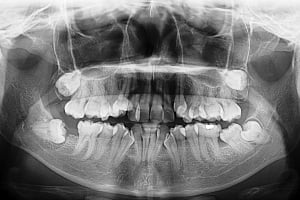 How Common Is Hyperdontia (Extra Teeth)?