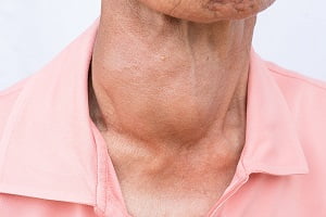 Thyroid Cancer in Females