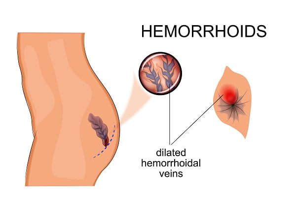 Hemorrhoid Pillow, Hemorrhoid Cushion and Hemorrhoid Pads