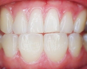Relationship Between Stress and Teeth Grinding (Bruxism)