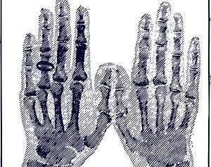 Arthritis Symptoms in Fingers and Hands