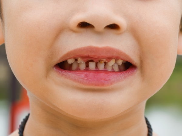 Kids Rotten Teeth Prevention DiseaseFix   Kids Rotten Teeth 