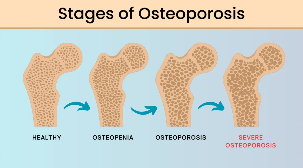 Stages of Osteoporosis