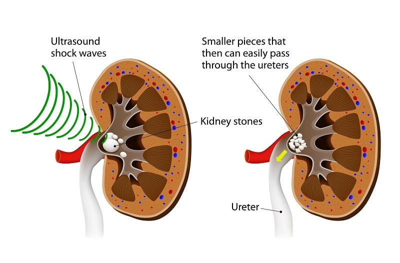 Extracorporeal Shock Wave Lithotripsy (ESWL)