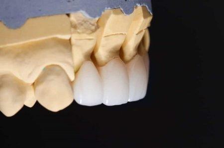 dental crowns