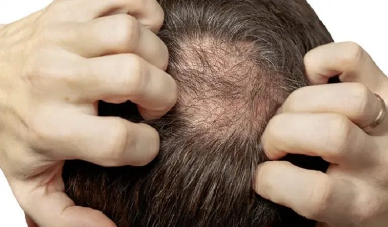 hair loss treatments