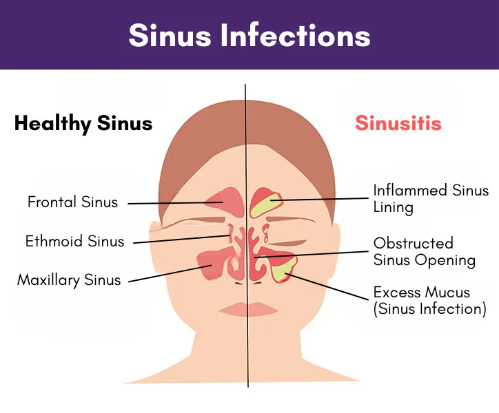 Sinus Infections