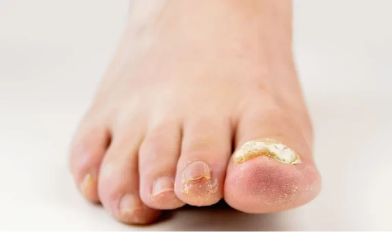 Toenail Fungus