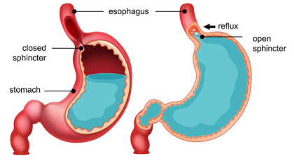 gerd-reflux-acid-disease