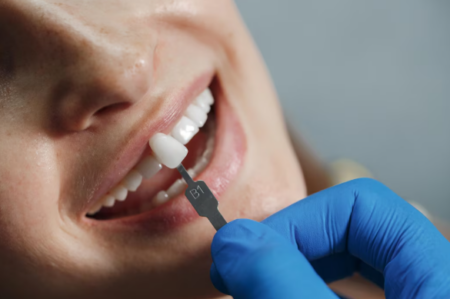 Dental implant procedure showing titanium post placed in jawbone with crown for missing tooth replacement.
